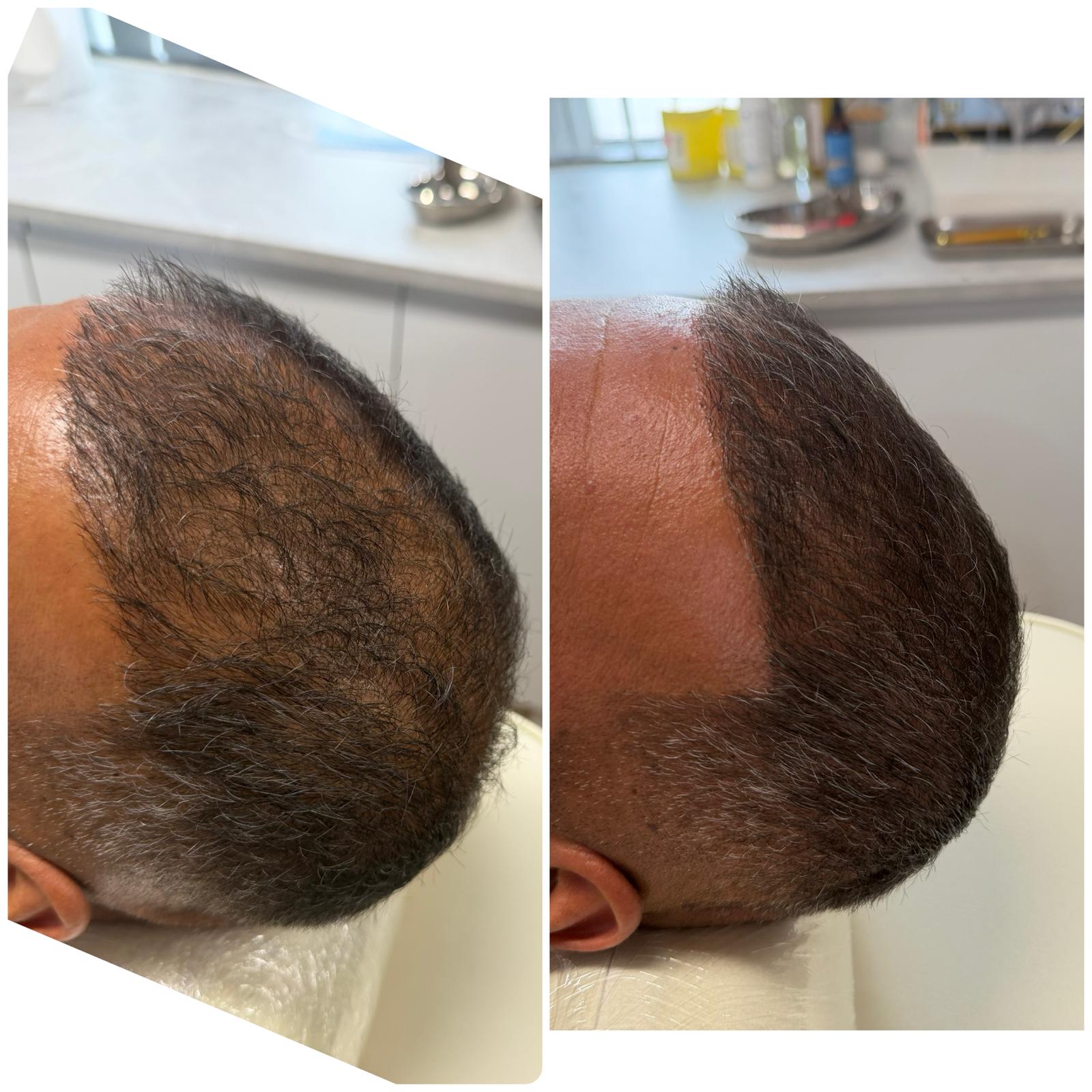 Before and after hair restoration result 4 at Infinity Hair Loss Clinic