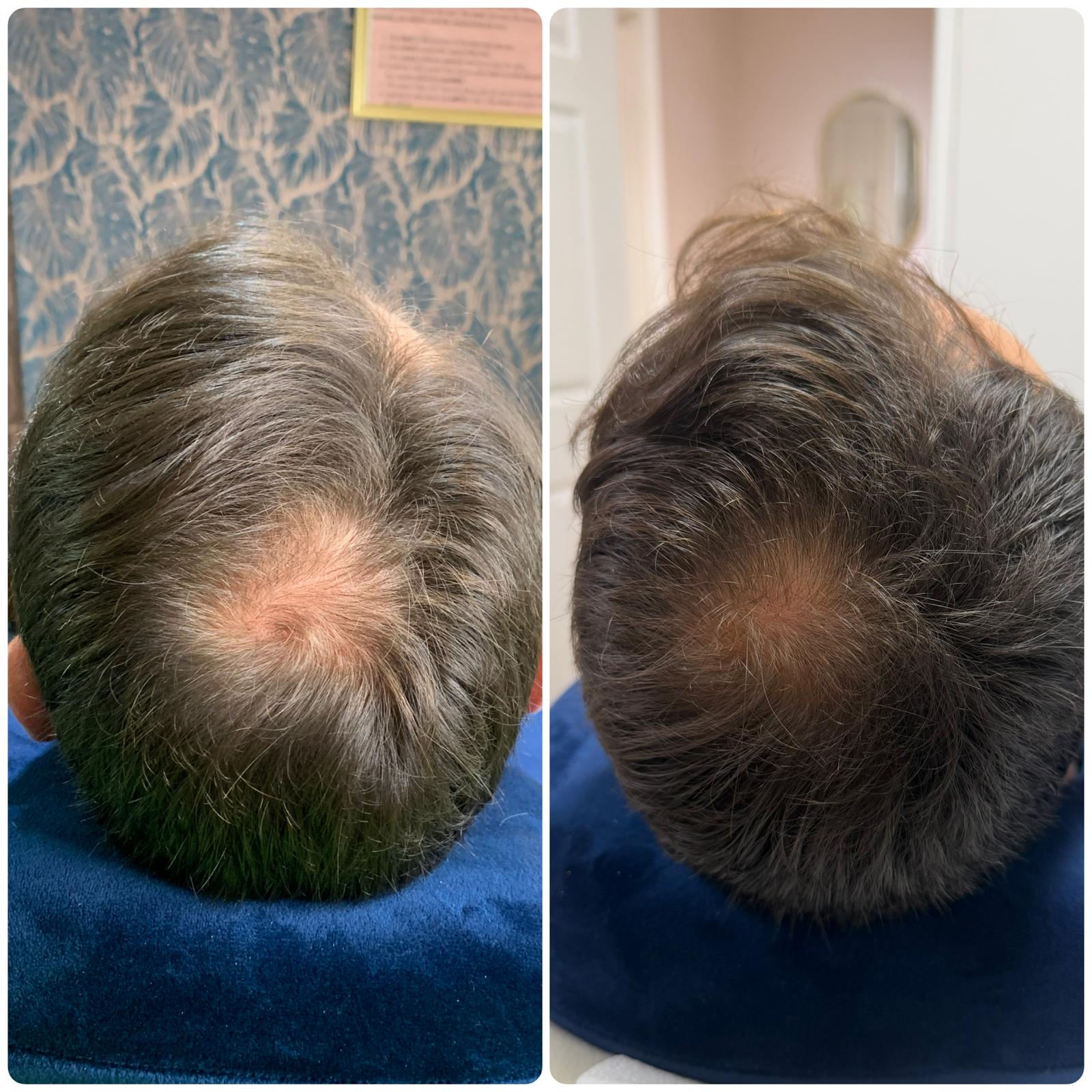 Before and after hair restoration result 1 at Infinity Hair Loss Clinic