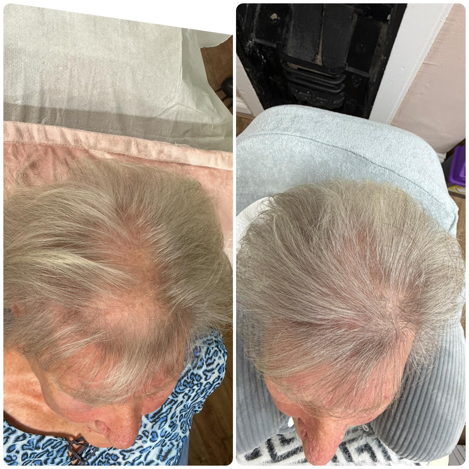 Before and after hair restoration result 1 at Infinity Hair Loss Clinic
