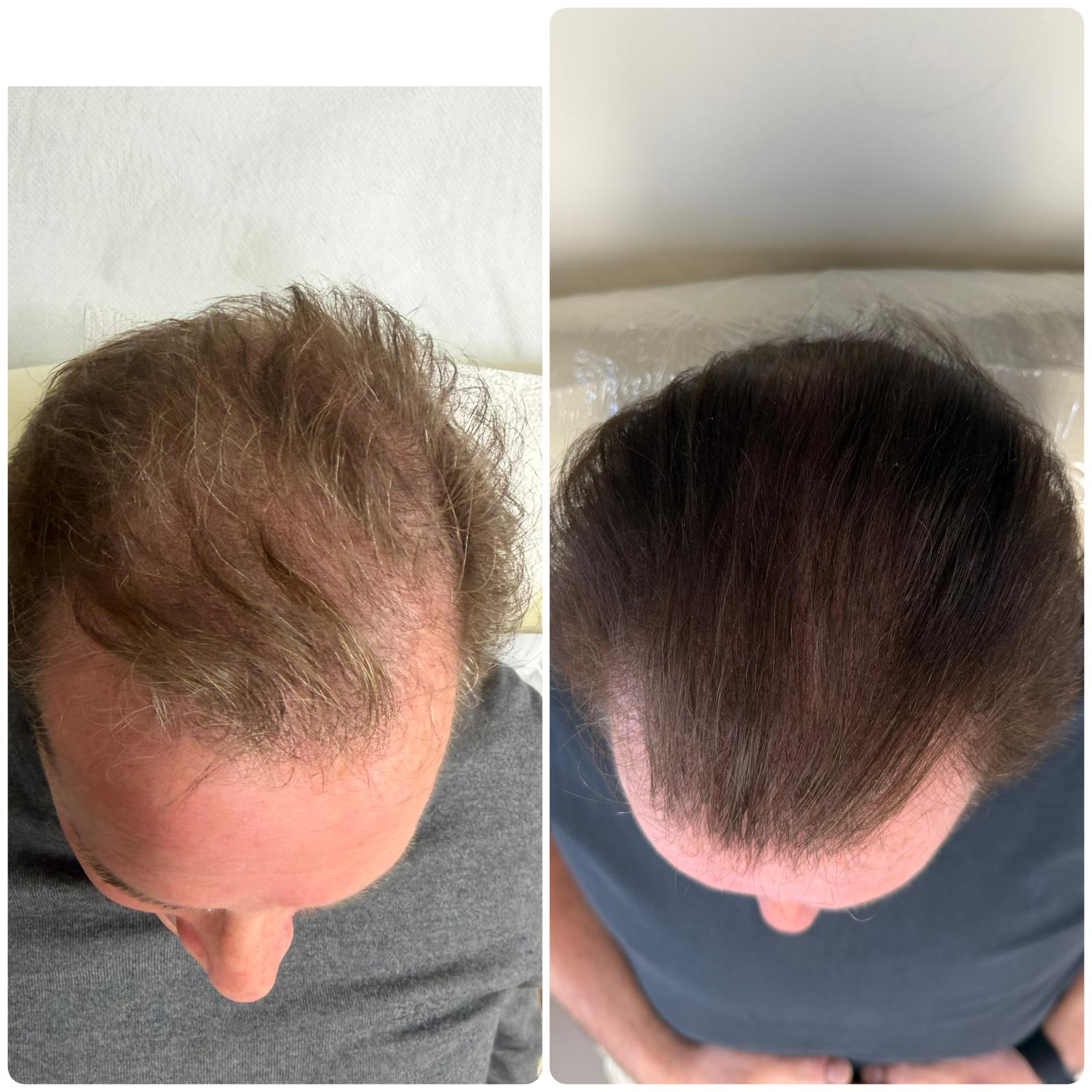 Before and after hair restoration result 2 at Infinity Hair Loss Clinic
