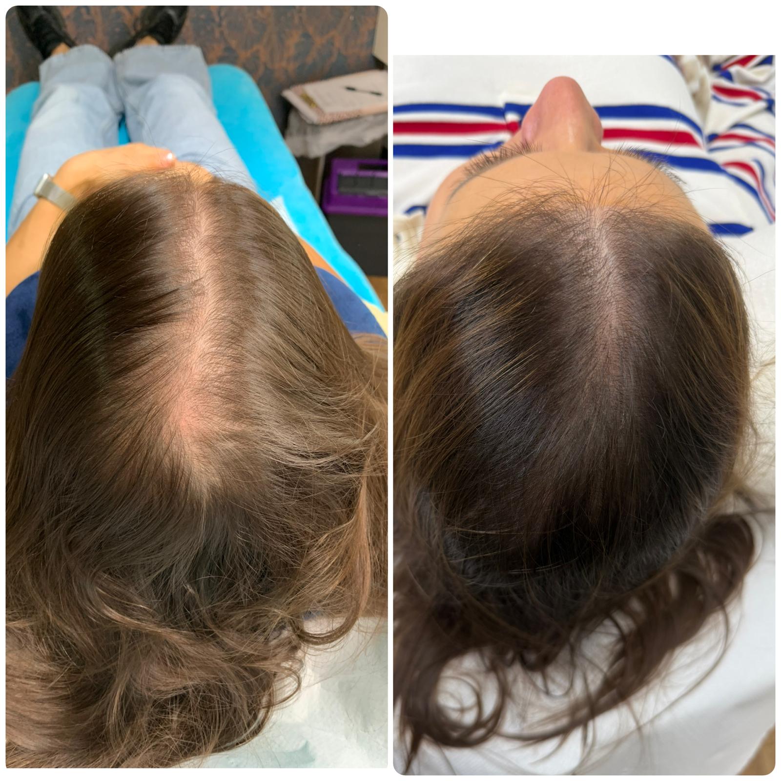 Before and after hair restoration result 2 at Infinity Hair Loss Clinic
