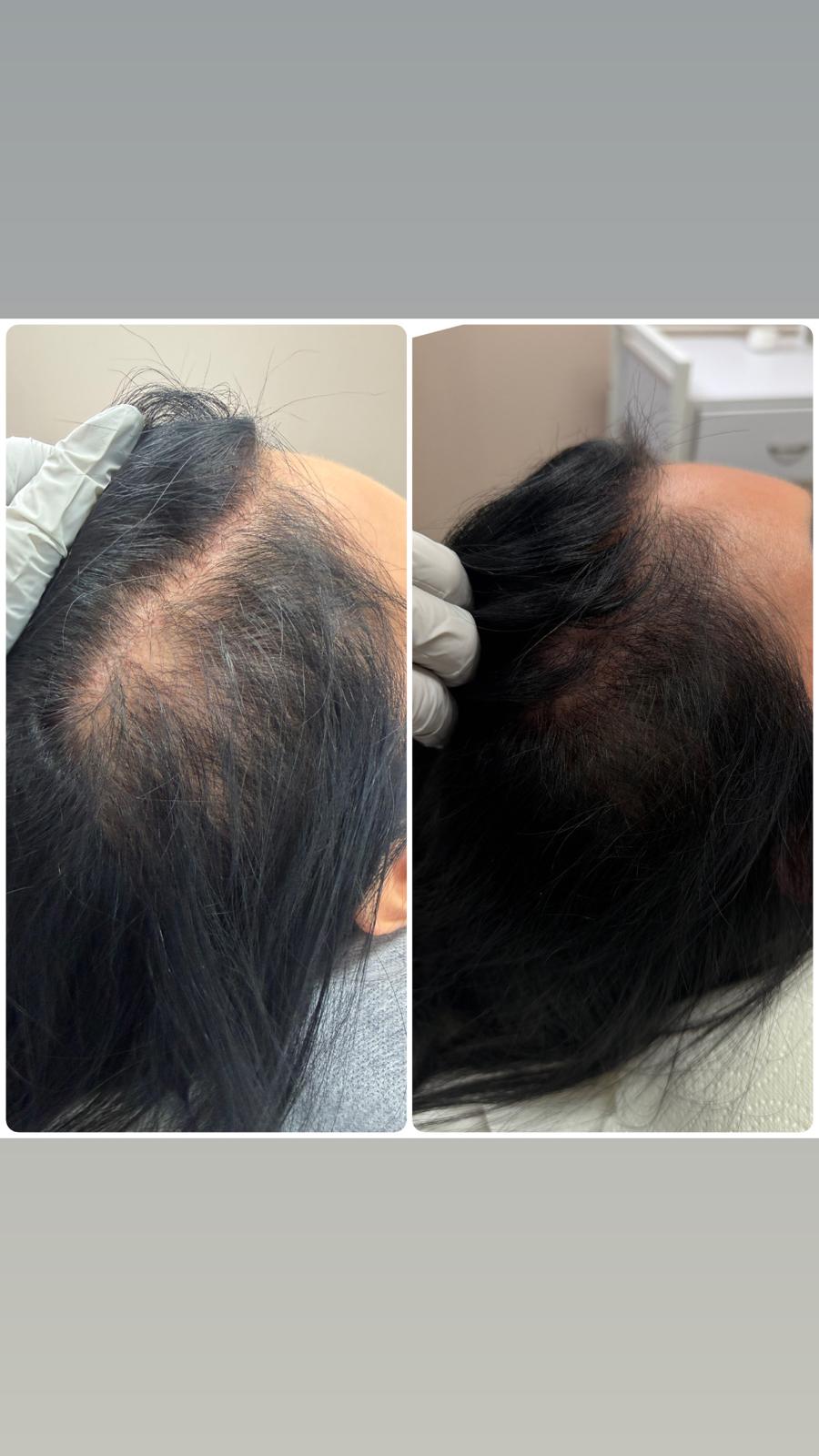 Before and after hair restoration result 3 at Infinity Hair Loss Clinic