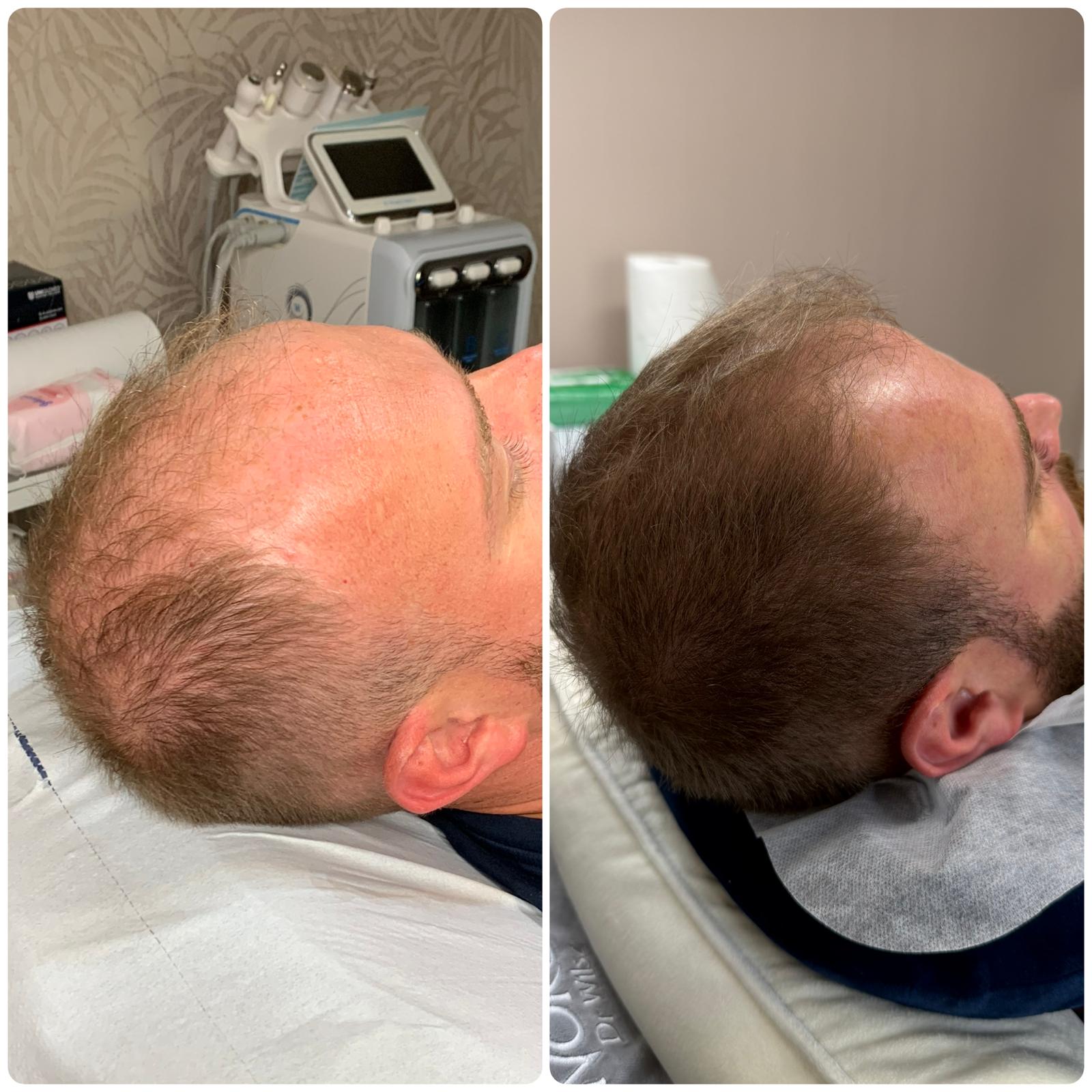 Before and after hair restoration result 3 at Infinity Hair Loss Clinic